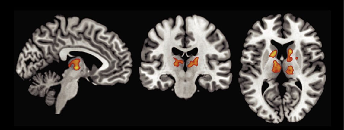 Three different MRI brain scans showing the brain's structure in sagittal, coronal, and axial planes. Certain areas are highlighted in orange, indicating regions of interest or activation within the brain—much like the investigative approach seen in Berkeley Journalism.